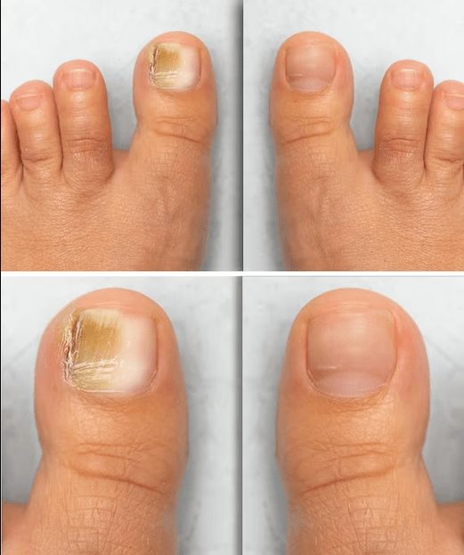 Foot Fungus - Πριν και μετά τη θεραπεία με Fungeent Cream