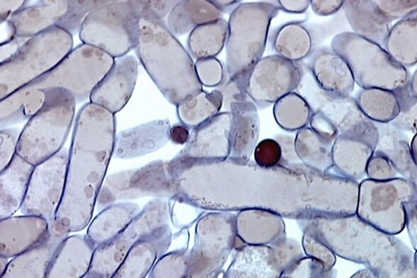 Κύτταρα μύκητα νυχιών κάτω από το μικροσκόπιο